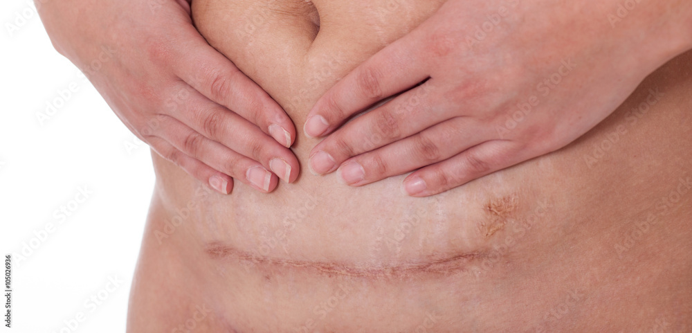 Scar after a Caesarean section, Bikini line Scar after a Caesarean section, Bikini line
