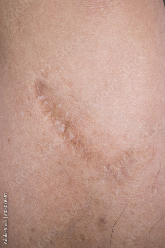 Old scar
