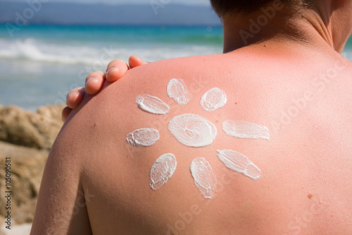 Sunburn and suncream on the shoulder of a young man