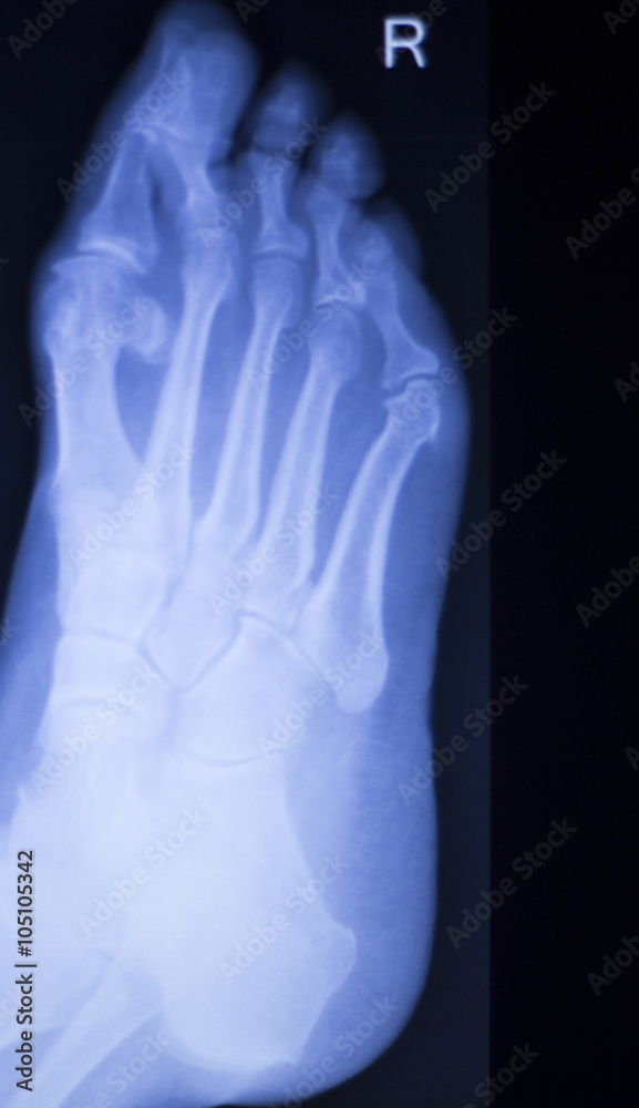Foot and toes injury xray scan Foot and toes injury xray scan