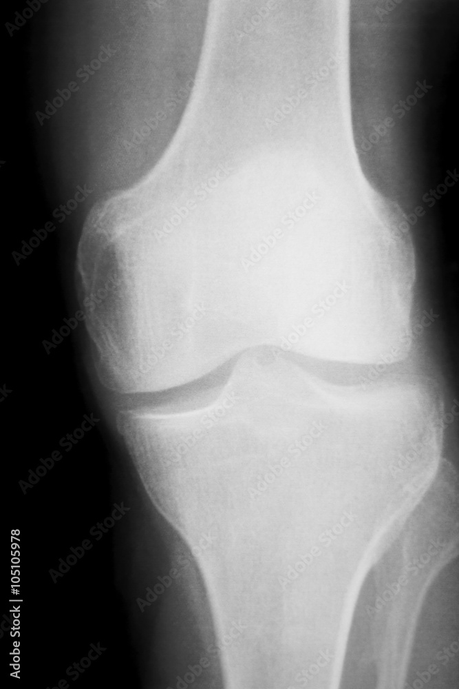 Naklejka premium Knee and meniscus injury xray scan
