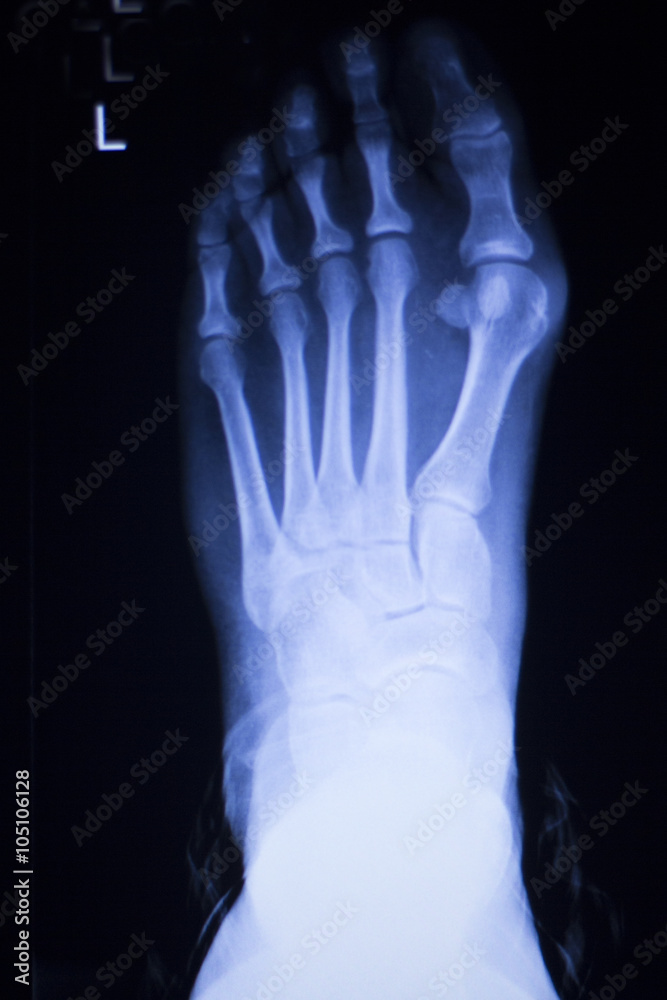 Foot and toes injury xray scan Foot and toes injury xray scan