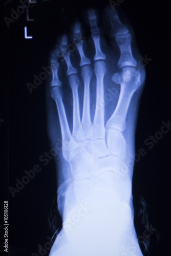 Foot and toes injury xray scan © edwardolive