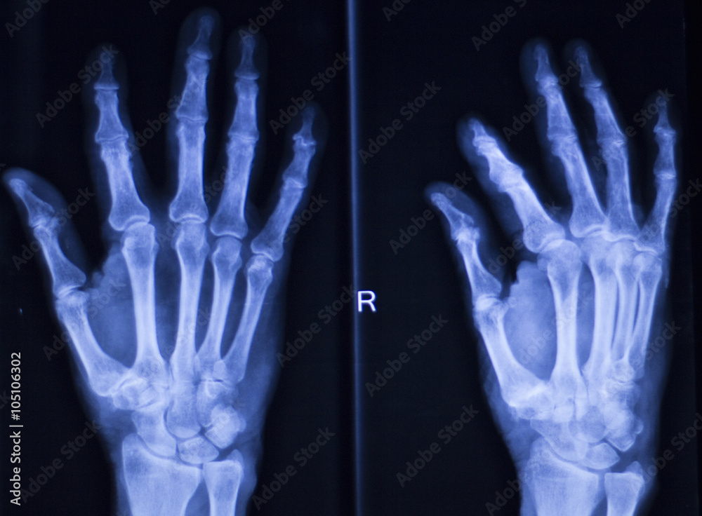 Hand fingers thumb wrist xray scan Hand fingers thumb wrist xray scan