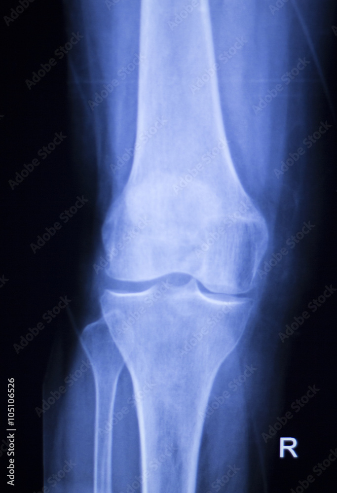 Knee and meniscus injury xray scan