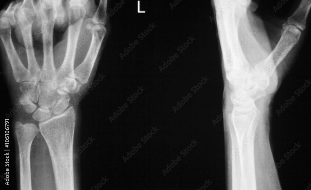 Hand fingers thumb wrist xray scan Hand fingers thumb wrist xray scan