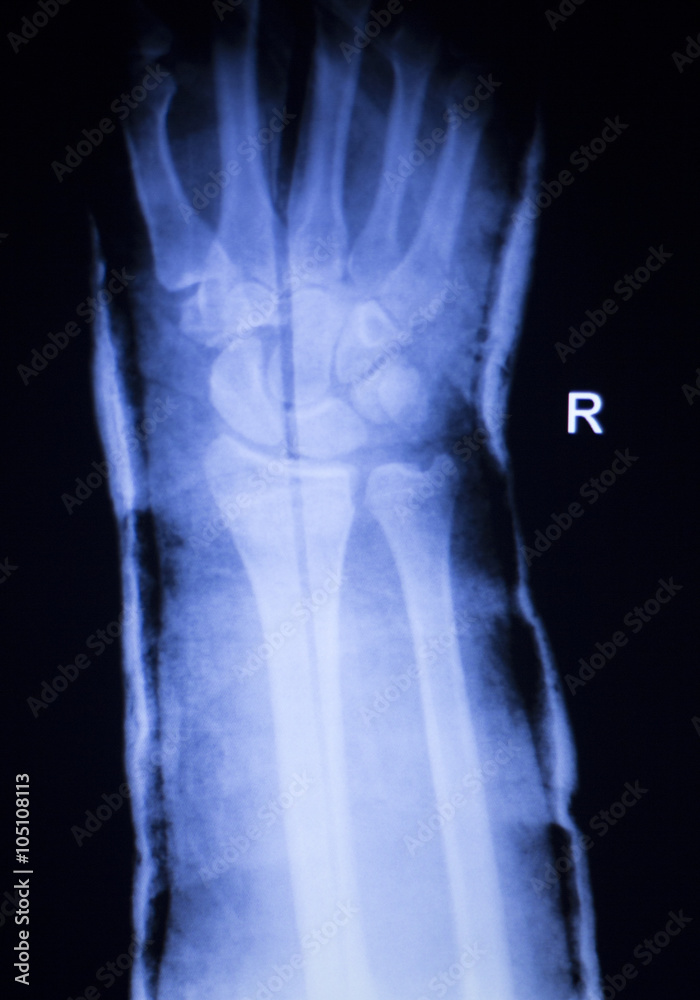 Forearm arm and wrist xray scan Forearm arm and wrist xray scan