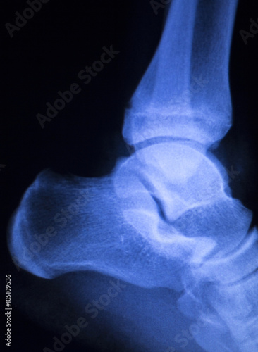 Foot heel ankle injury xray scan