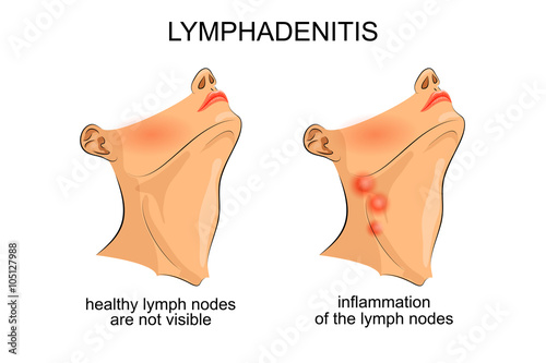 lymphadenitis . inflammation of the lymph nodes photo