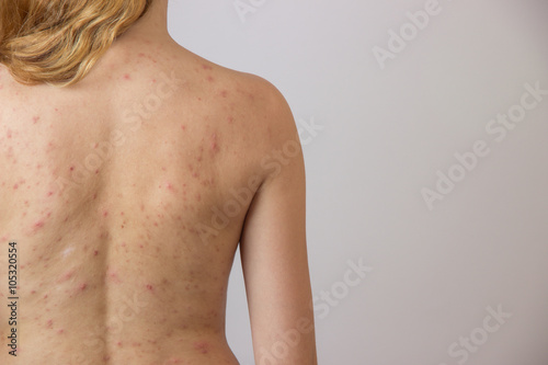 Young girl with acne, with red spots on the back