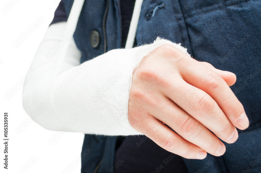 Fototapeta premium Broken elbow with medical bandage or gypsum
