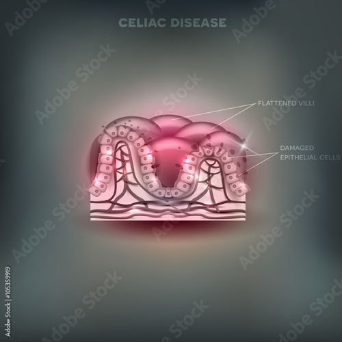 Celiac disease