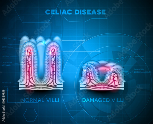 Celiac disease affected small intestine villi. Healthy villi and unhealthy villi with damaged cells on a blue technology background