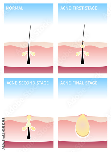 How acne happen. acne stages, vector