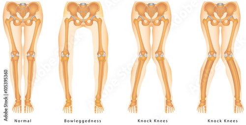 Shape of the legs - Genu varum, genu valgum 
