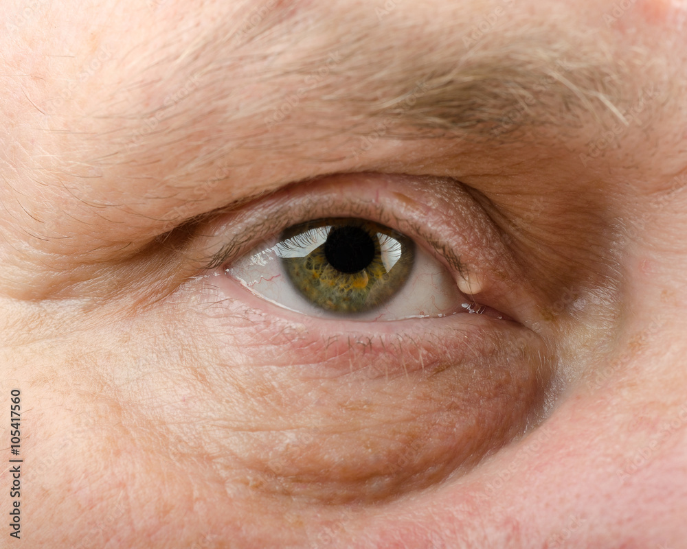 Cyst of right eyelid Cyst of right eyelid
