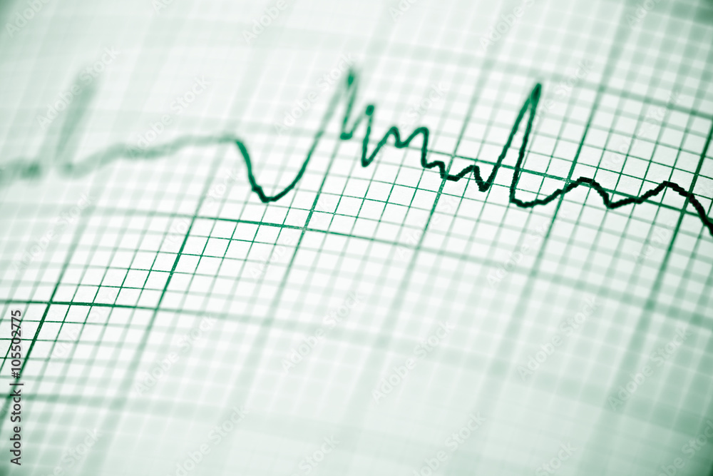 Electrocardiogram Electrocardiogram