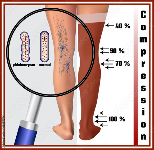 Phlebeurysm. Varicose veins.  Medicine. Diseases of the man. Compression hosiery.