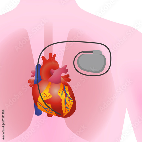 the heart of human and artificial cardiac pacemaker, vector illustration