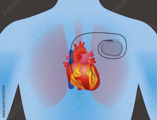 the heart of human and artificial cardiac pacemaker, vector illustration