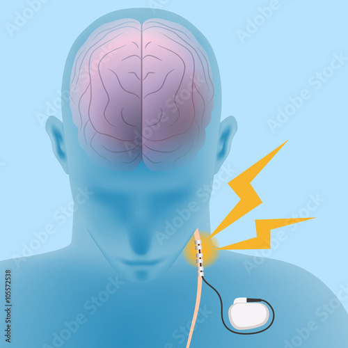 human brain and vagus nerve stimulation:VNS, image illustration