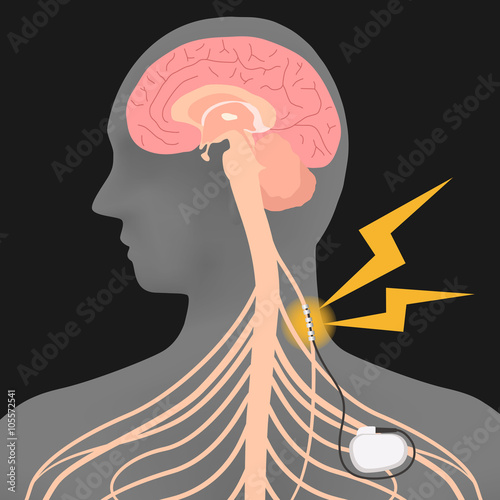 human brain and vagus nerve stimulation:VNS, image illustration