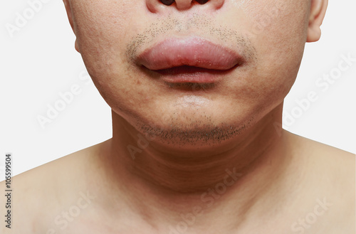 The skin around the mouth caused by an allergic reaction to medication. photo