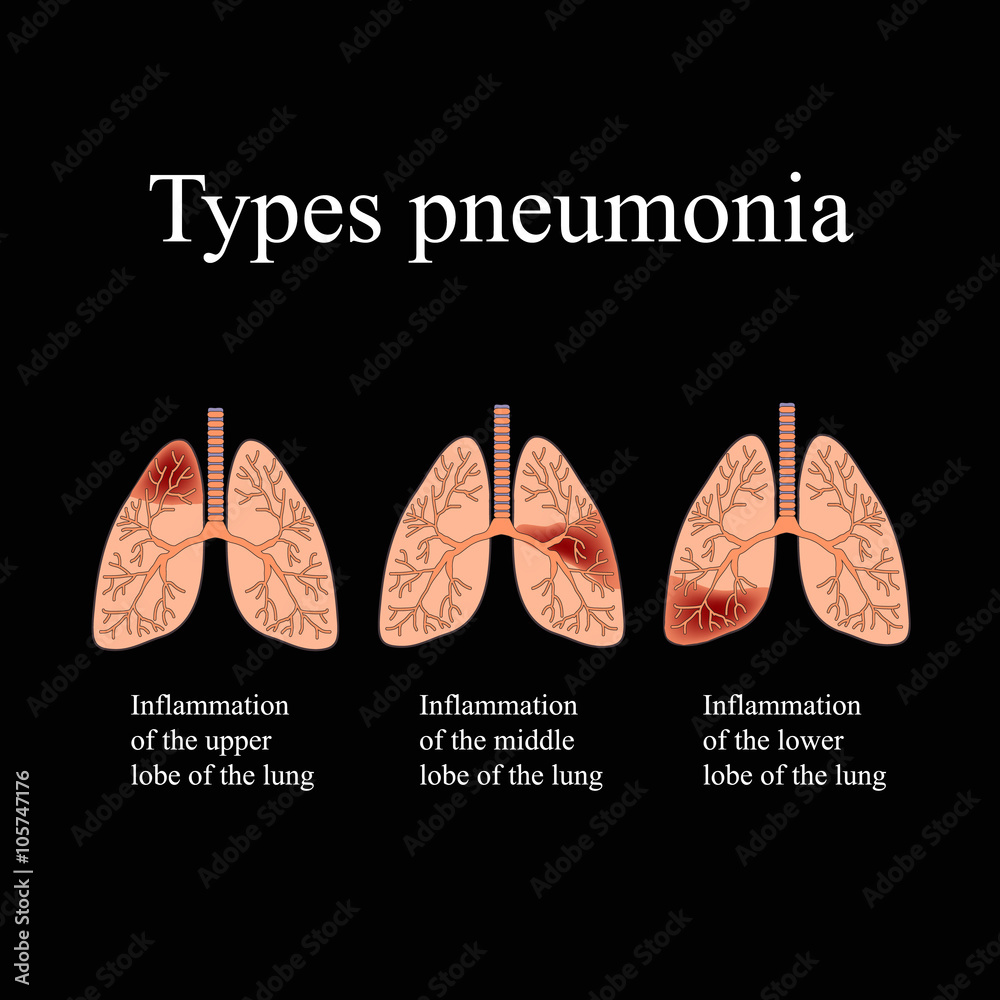 Pneumonia. The anatomical structure of the human lung. Type of