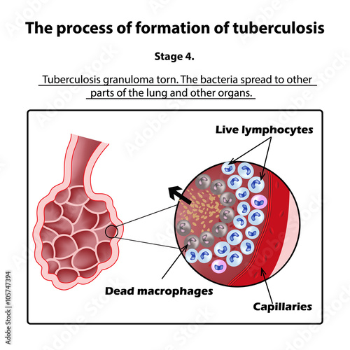 The development of tuberculosis. Stage 4. Infographics. Vector illustration on isolated background