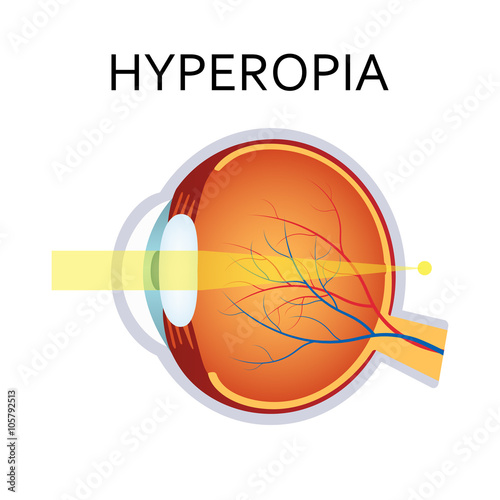 Hyperopia eyesight disorder.