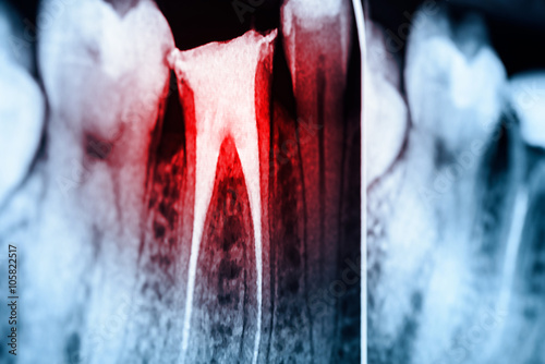 Full Obturation of Root Canal Systems On Teeth X-Ray photo