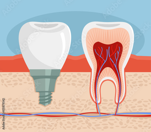Dental implant. Vector flat illustration