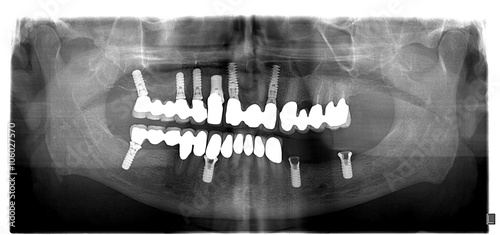Dental x-ray with periodontitis problems