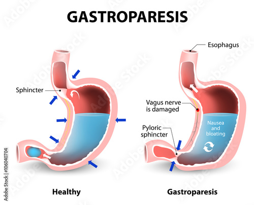 Gastroparesis photo