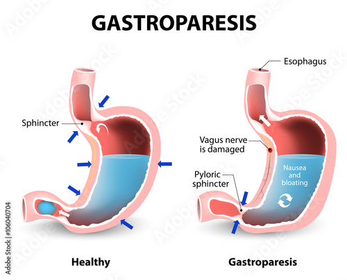 Gastroparesis