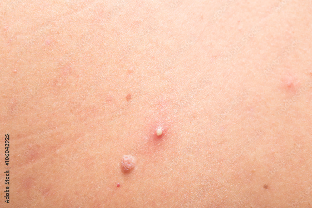 mole and pimple mole and pimple