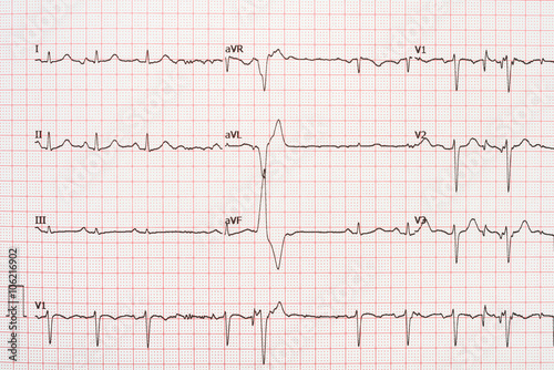 Extrasystole On 12 Lead Electrocardiogram Record Paper