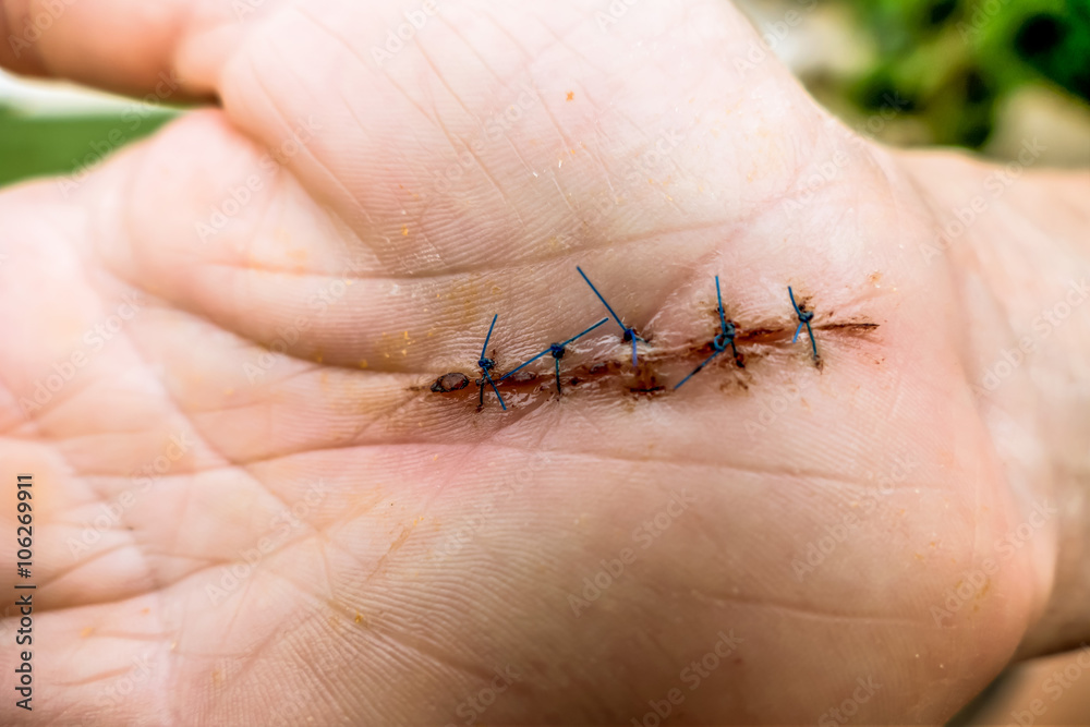 Obraz premium Karpaltunnelsyndrom