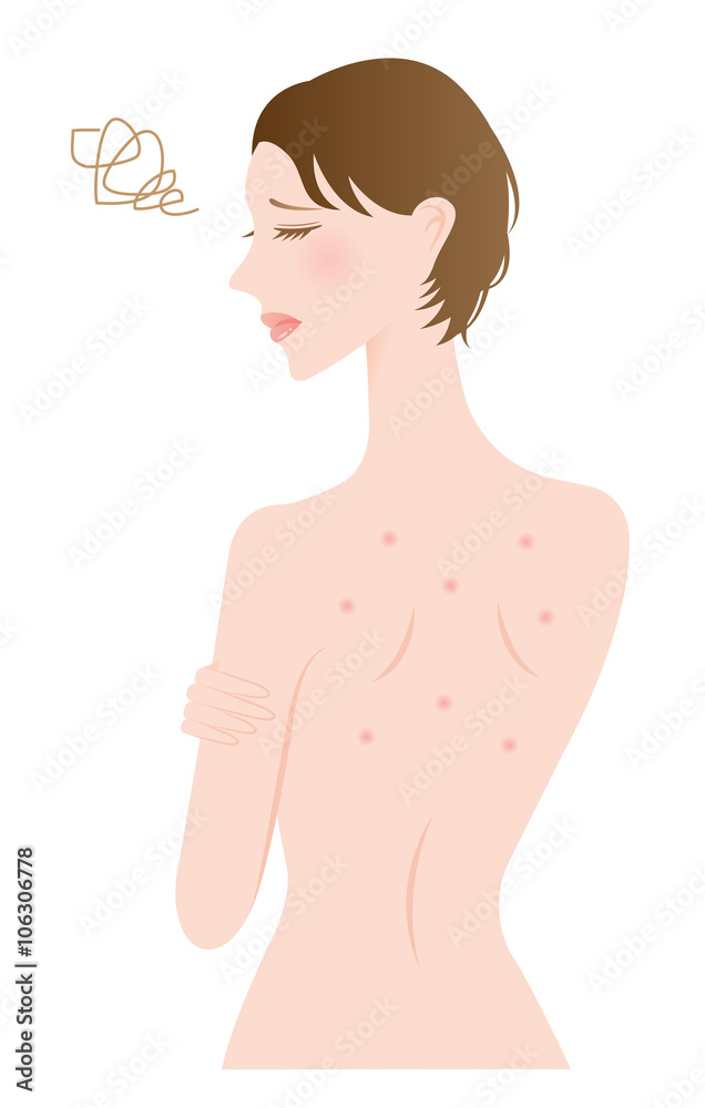 背中ニキビの女性