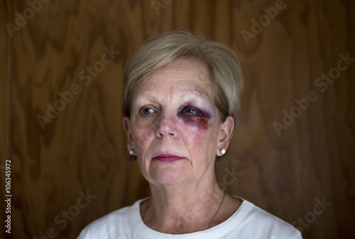 Portrait image of a mature woman with a bruised eye, with copy space.