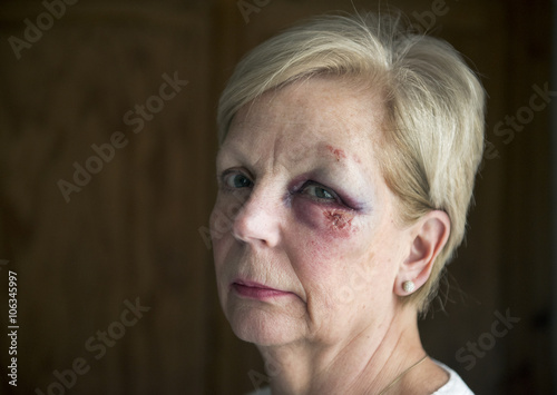 Portrait image of a mature woman with a bruised eye, with copy space.