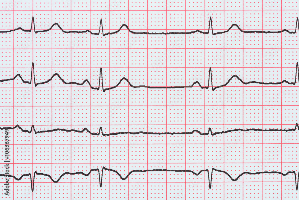 Sinus Heart Rhythm On Electrocardiogram Record Paper Showing Normal P Wave, PR and QT Interval and QRS Complex