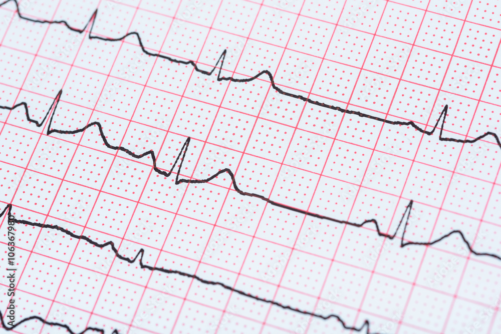 Sinus Heart Rhythm On Electrocardiogram Record Paper Showing Normal P Wave, PR and QT Interval and QRS Complex Sinus Heart Rhythm On Electrocardiogram Record Paper Showing Normal P Wave, PR and QT Interval and QRS Complex