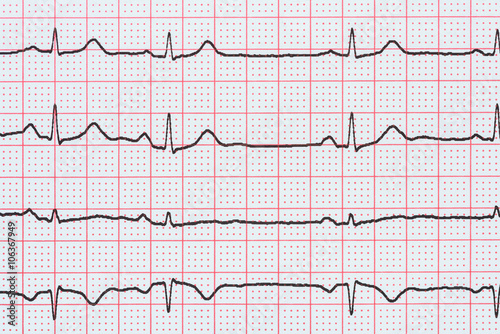 Sinus Heart Rhythm On Electrocardiogram Record Paper Showing Normal P Wave, PR and QT Interval and QRS Complex