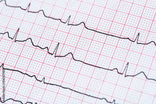 Sinus Heart Rhythm On Electrocardiogram Record Paper Showing Normal P Wave, PR and QT Interval and QRS Complex