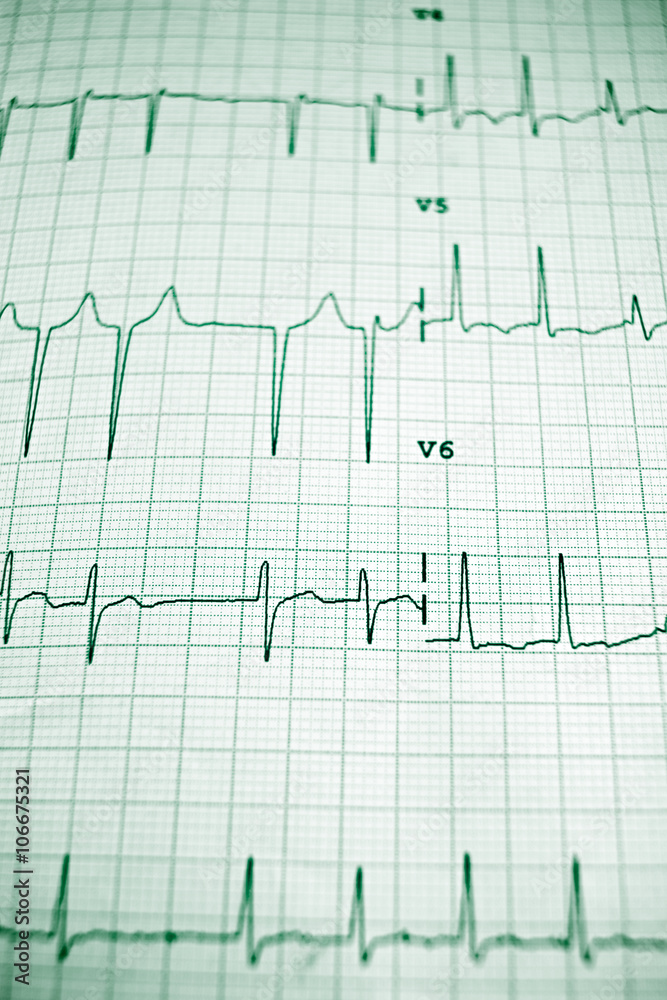 Electrocardiogram