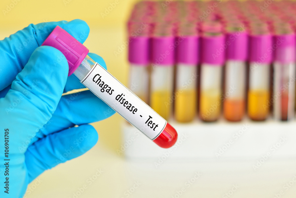 Naklejka premium Chagas disease (American trypanosomiasis) test 