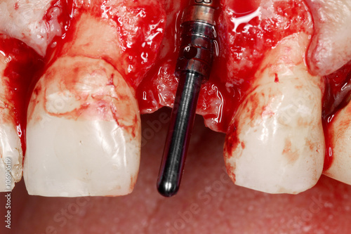 real dental implant surgery