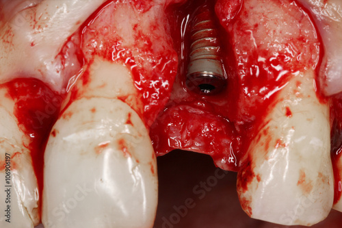 Dental surjery implant view
