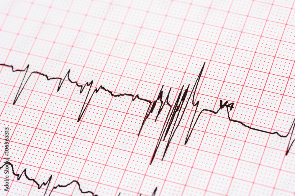Extrasystoles On Electrocardiogram Record Paper Extrasystoles On Electrocardiogram Record Paper